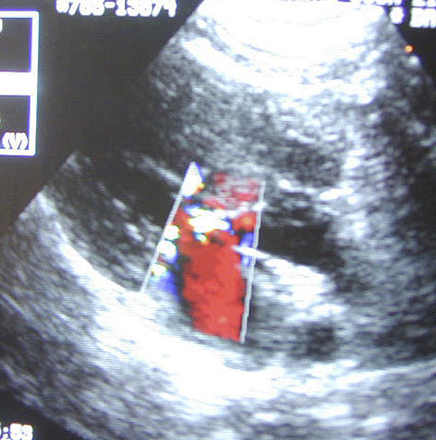 PDA—Congenital Heart Disease in Dogs • the Hilo